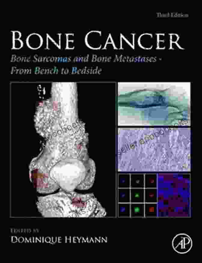 Book Cover Of 'Bone Sarcomas And Bone Metastases: From Bench To Bedside' Bone Cancer: Bone Sarcomas And Bone Metastases From Bench To Bedside