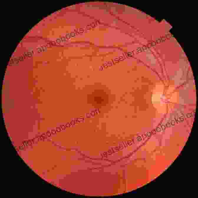 Fundus Photograph Of A Healthy Eye Essential Ophthalmoscopy For Medical Students And General Healthcare Practitioners (Ridgevue)