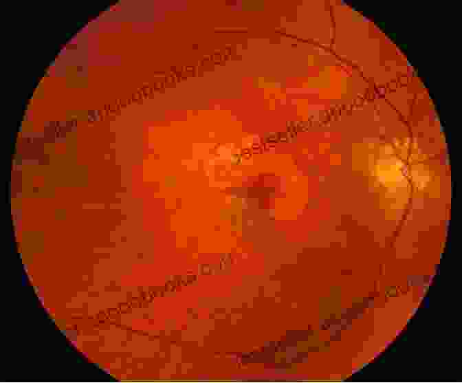 Fundus Photograph Of Macular Degeneration Essential Ophthalmoscopy For Medical Students And General Healthcare Practitioners (Ridgevue)