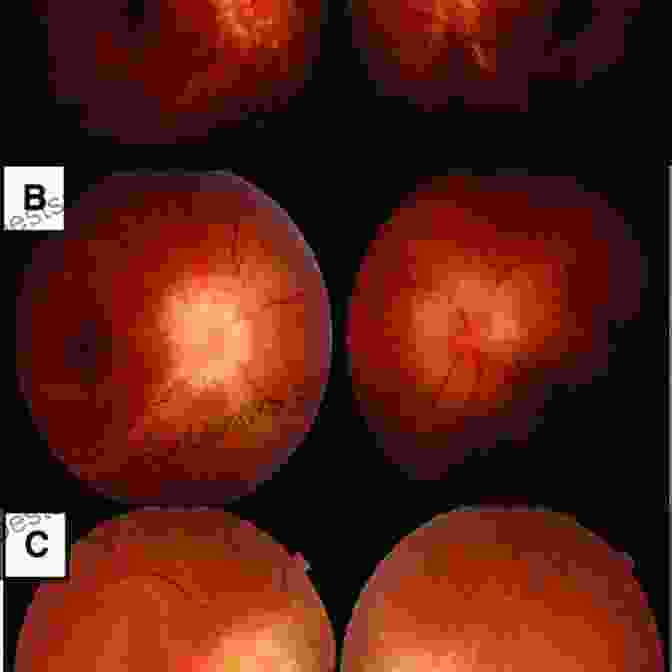 Fundus Photograph Of Papilledema Essential Ophthalmoscopy For Medical Students And General Healthcare Practitioners (Ridgevue)