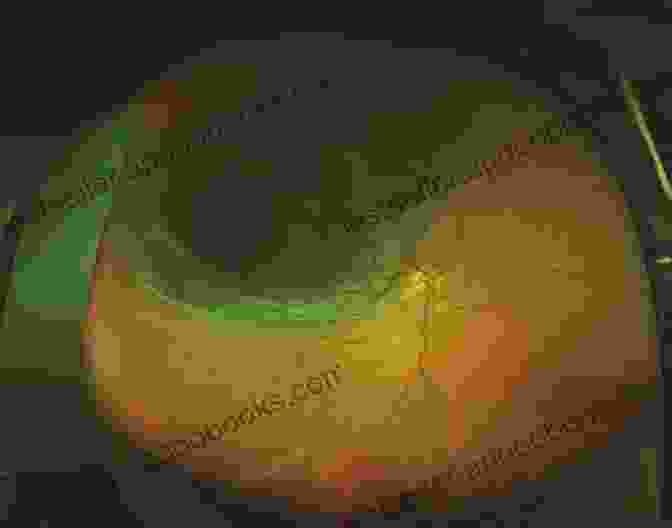 Fundus Photograph Of Retinal Detachment Essential Ophthalmoscopy For Medical Students And General Healthcare Practitioners (Ridgevue)