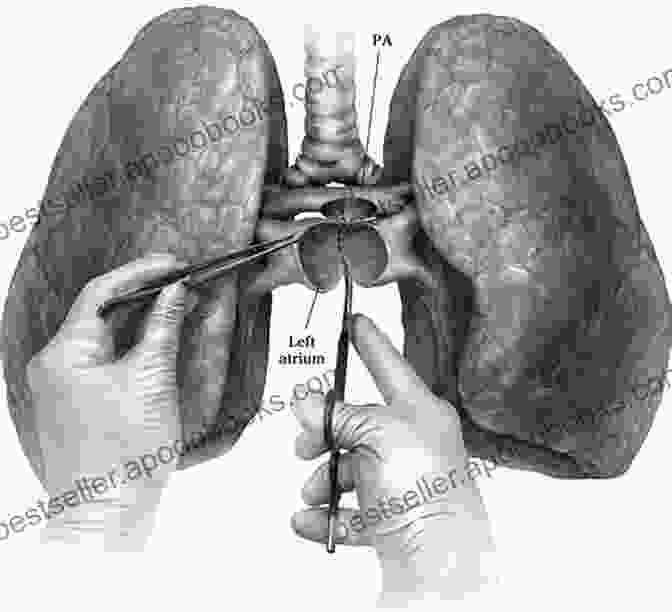 Illustration Of Surgical Techniques Used In Lung Transplantation Lung Transplantation: Principles And Practice