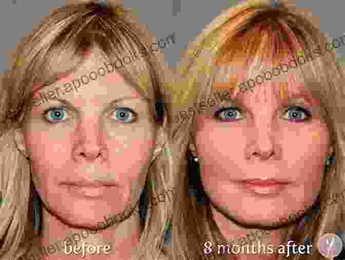 Image Of Before And After Facelift Results Dissecting The Facelift Jerry Boyd